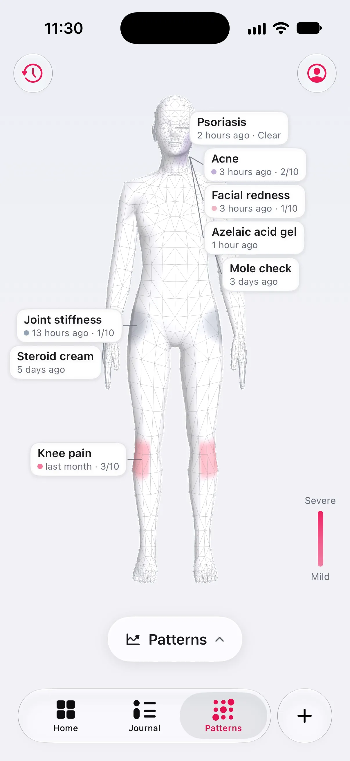 Longnote’s body atlas: a 3-D figure with the hips and both knees tinted, and dated callouts reading psoriasis 20 hours ago, clear; mole check 3 days ago; joint stiffness 8 hours ago, 1 of 10; steroid cream 5 days ago; and knee pain last month, 3 of 10, beside a mild-to-severe scale.