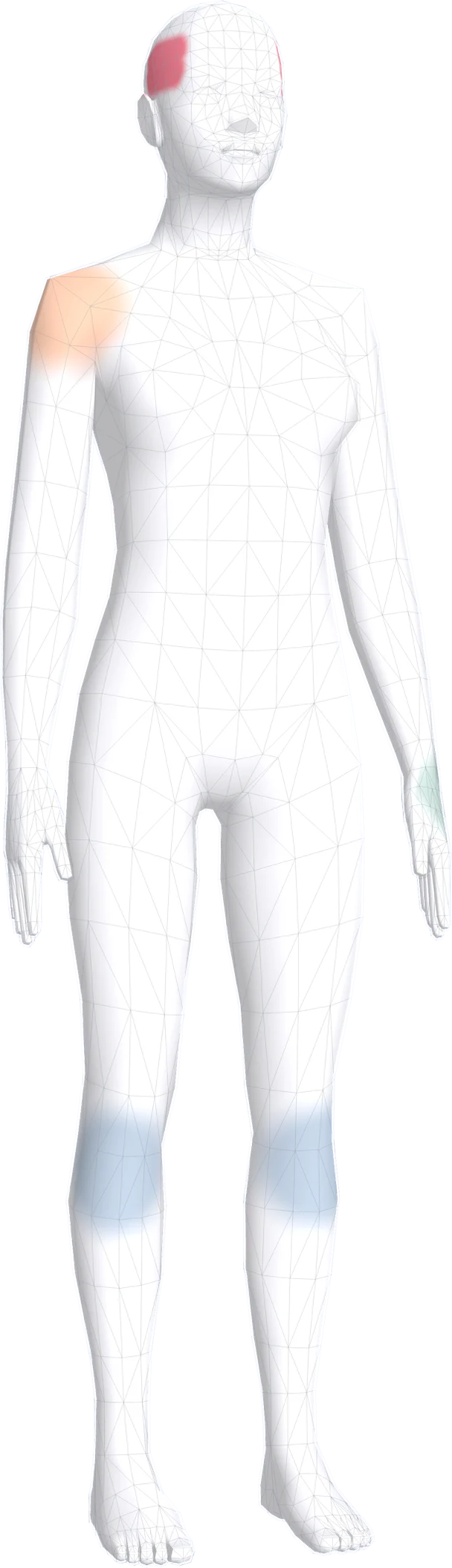 Longnote’s 3-D body, turned a little, with sample areas tinted in tracker colours: a small painted patch on each side of the head, above the temples, in raspberry at near-full strength for a severe migraine, the right shoulder in apricot at medium strength, both knees in pale blue for mild to moderate, and the left wrist in a faint teal for mild.